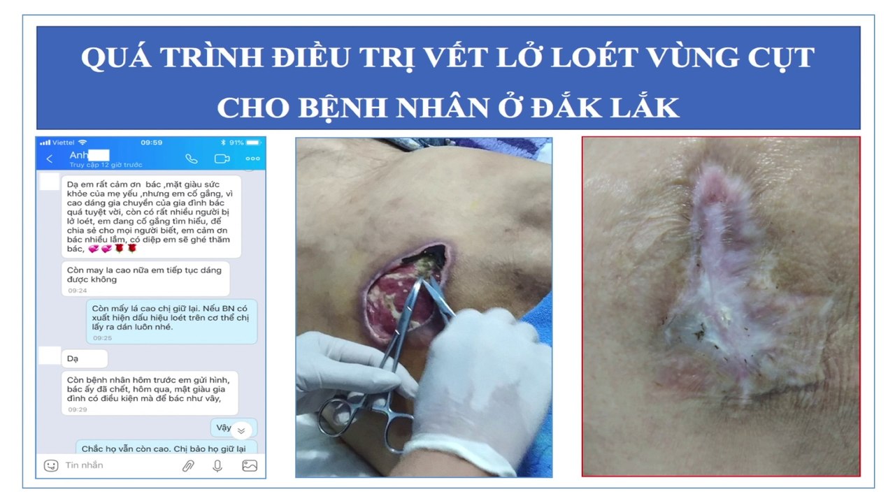 Điều trị lở loét cho bệnh nhân ở Đăk Lăk| Lở loét vùng cùng cụt | Thuốc trị lở loét da