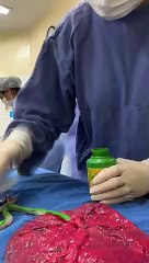 Vídeo: Veja como é feito o enquadramento de placenta