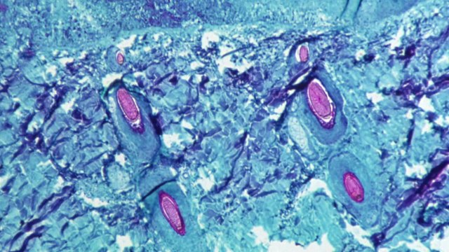 일주일 새 국내 발생 5건...키워드로 보는 엠폭스 / YTN