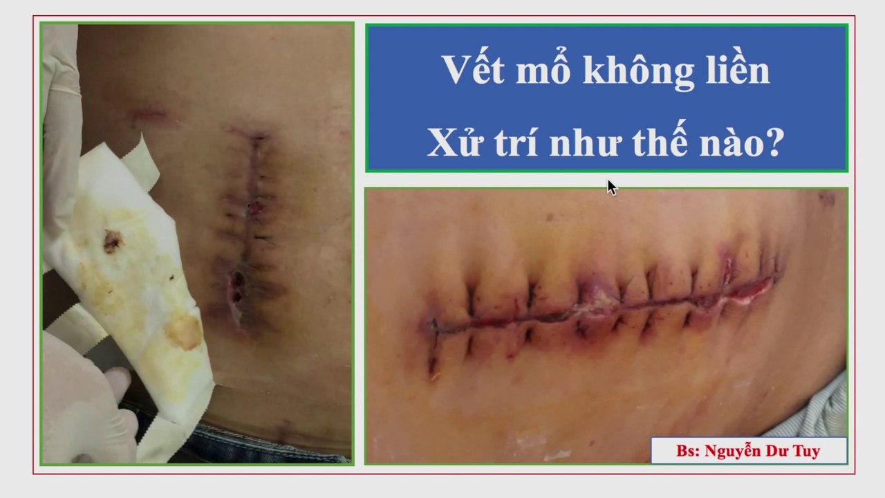 Xử trí vết mổ không liền | Nhiễm trùng vết mổ | Chăm sóc nhiễm trùng vết mổ