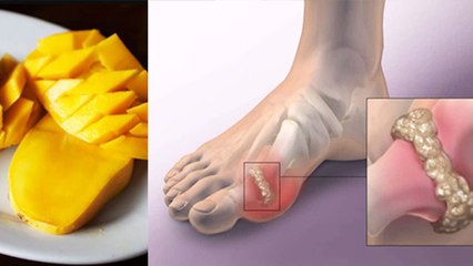 यूरिक एसिड में आम खाना चाहिए या नहीं | क्या आम खाने से यूरिक एसिड बढ़ता है | Boldsky