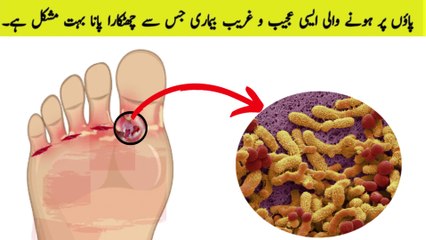 what is Athelet's foot | How Athelet's foot affects our feet | #teniapedis #atheletesfoot #feetfungi