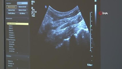 Yaşlı adam, şah damarına yapılan anjiyografiyle sağlığına kavuştu