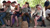 Dermatólogos internacionales ayudan a tratar el cáncer de piel de albinos en Mozambique
