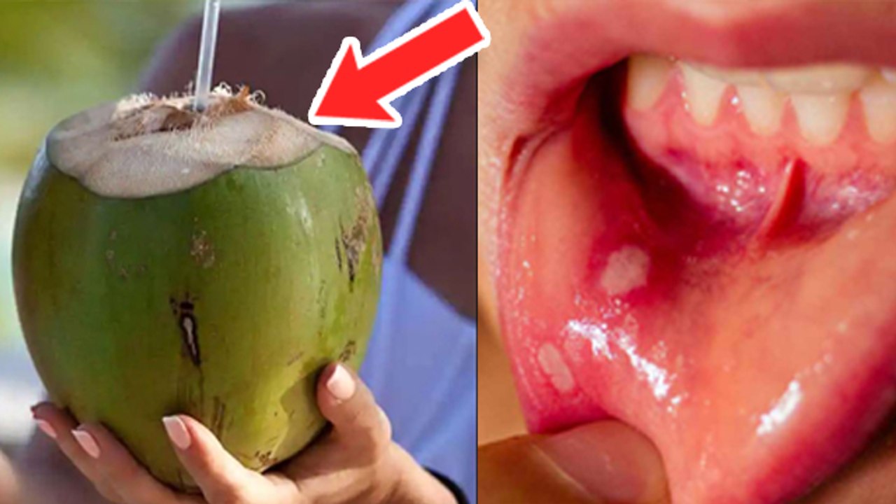 Coconut Water से Mouth Ulcer कैसे ठीक करें Muh Ke Chale Nariyal Pani