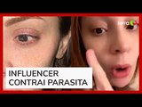 Influenciadora contrai parasita carnívoro ao usar lentes de contato; veja