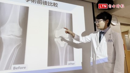 75歲婦人成功用AI機器手臂精準置換人工關節，重拾行動力🚶‍♀️