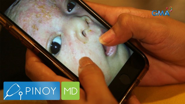 Ano ang neonatal acne sa mga sanggol at paano ito maiiwasan? | Pinoy MD