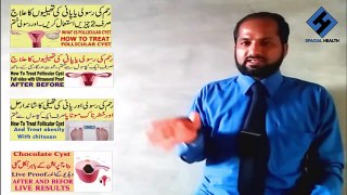 How To Treat Follicular Cyst | Reham ki Rasoli Ka Ilaj | Pani ki Thelion Ka Ilaj Urdu 2023