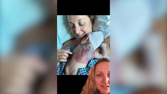 Baby with turtle shell growth due to rare skin condition nicknamed little ninja-turtle by parents