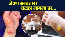 जेवण बनवताना भाजल्यावर काय कराल? | How To Treat Burns At Home | Home Remedies for Burns | AI2