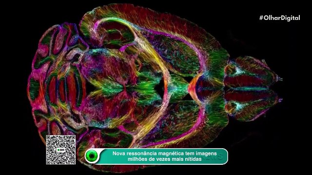 Nova ressonância magnética tem imagens milhões de vezes mais nítidas