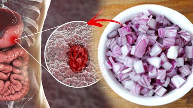 रोज कच्चा प्याज खाने से क्या होता है | Roj Kaccha Pyaaj Khane Se Kya Hota Hai |Boldsky