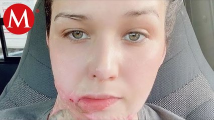 Liliana fue víctima de un violencia química en 2022; acusa que la CEAV le retiró el apoyo