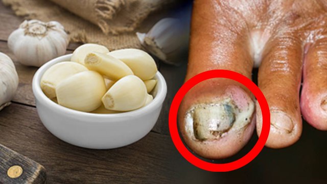 रोज लहसुन खाने से क्या होता है | Roj Lehsun Khane Se Kya Hota Hai | Boldsky