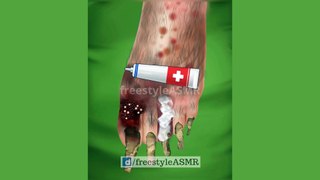 ASMR Foot Treatment Removal of Maggot Worms Insects and Bugs | #amsr #animation