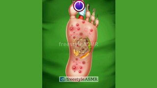 ASMR Foot Surgery Removal of Spiders, Spider Web, and Fungal Infection Treatment | #amsr #animation