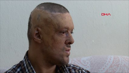 Yangında yüzü ve kafa derisi yanan Serhat: Dışlanıyorum