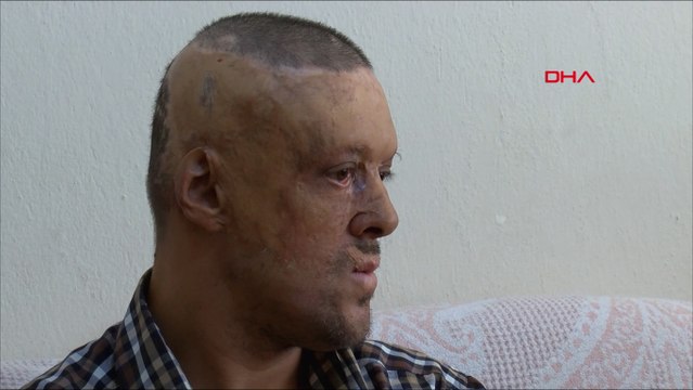 Yangında yüzü ve kafa derisi yanan Serhat: Dışlanıyorum