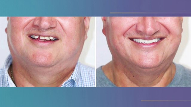 bd-como-limpiar-y-eliminar-el-sarro-en-dientes-apiñados-020523