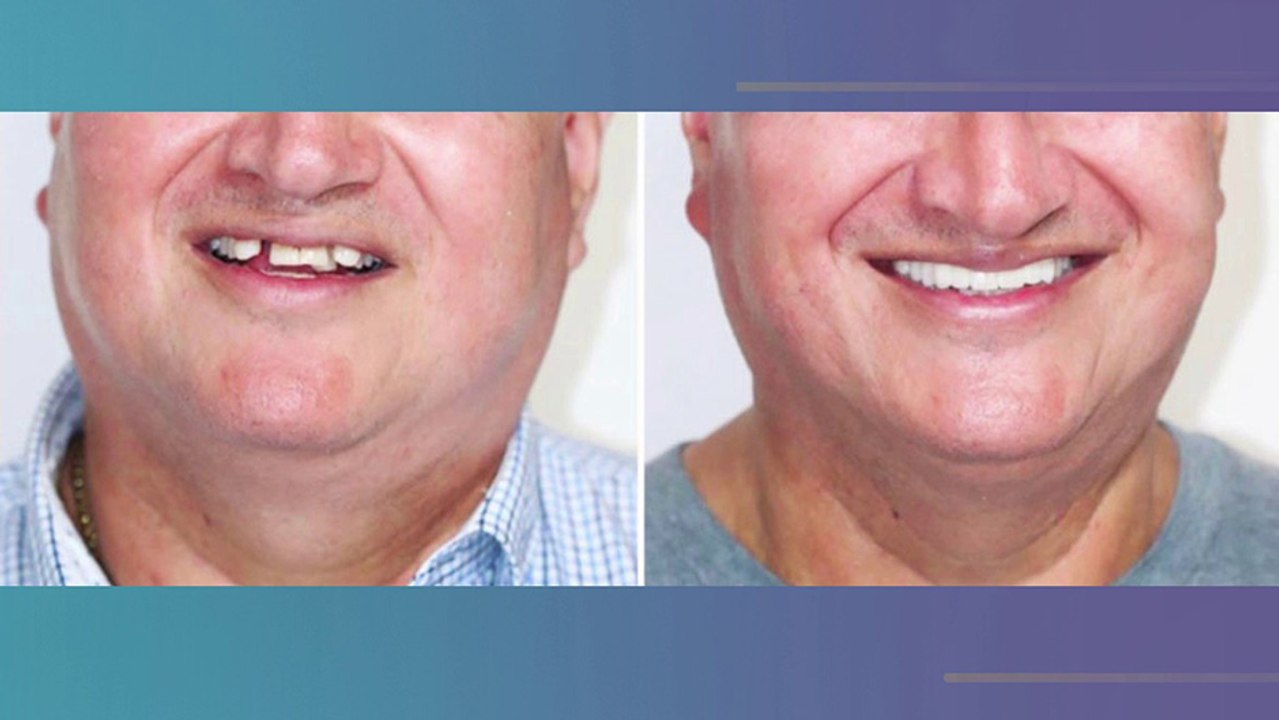 bd-como-limpiar-y-eliminar-el-sarro-en-dientes-apiñados-020523