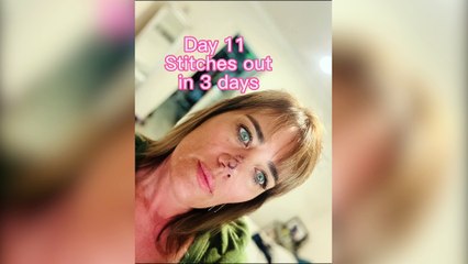 “I thought I had a pimple but it turned out to be skin cancer”