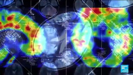 Alzheimer's treatment: New drug slows cognitive decline by 35%, studies show