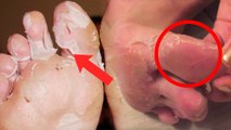 Foot Skin Peel का Reason Acral Peeling Skin Syndrome से लेकर Niacin Deficiency | Boldsky