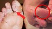 Foot Skin Peel का Reason Acral Peeling Skin Syndrome से लेकर Niacin Deficiency | Boldsky