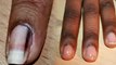 नाखून के आसपास की त्वचा काली क्यों पड़ती है | Nails Ke Aaspas Skin Par Kalapan Kyu Hota Hai |Boldsky