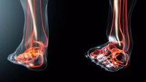 Curare i piedi con l'attività fisica, i consigli dell'ortopedico per alleviare il dolore