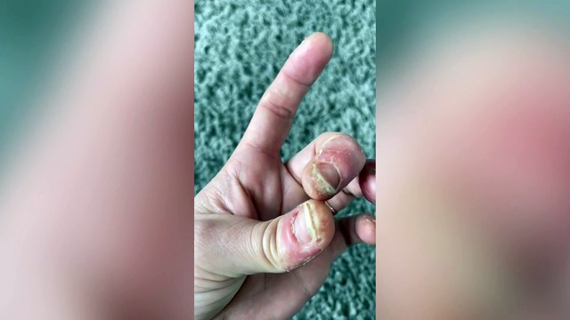Mum can barely use her hands after developing a suspected allergy - to nail products