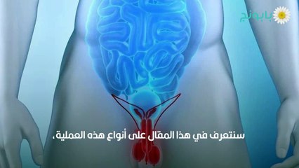 أنواع عملية دوالي الخصية وتأثير عملية الدوالي على الإنجاب