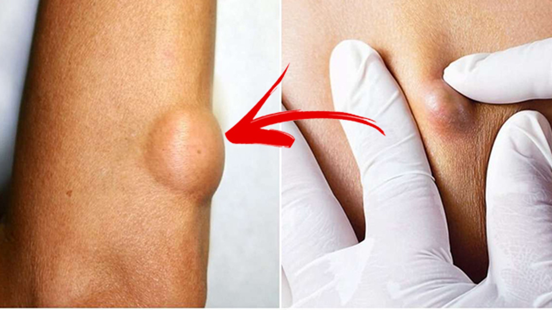 जांघ में गांठ होने के कारण Hernia Symptoms | Jangh Me Gath Hona | Jangh Me  Ganth Ka Ilaj | Boldsky