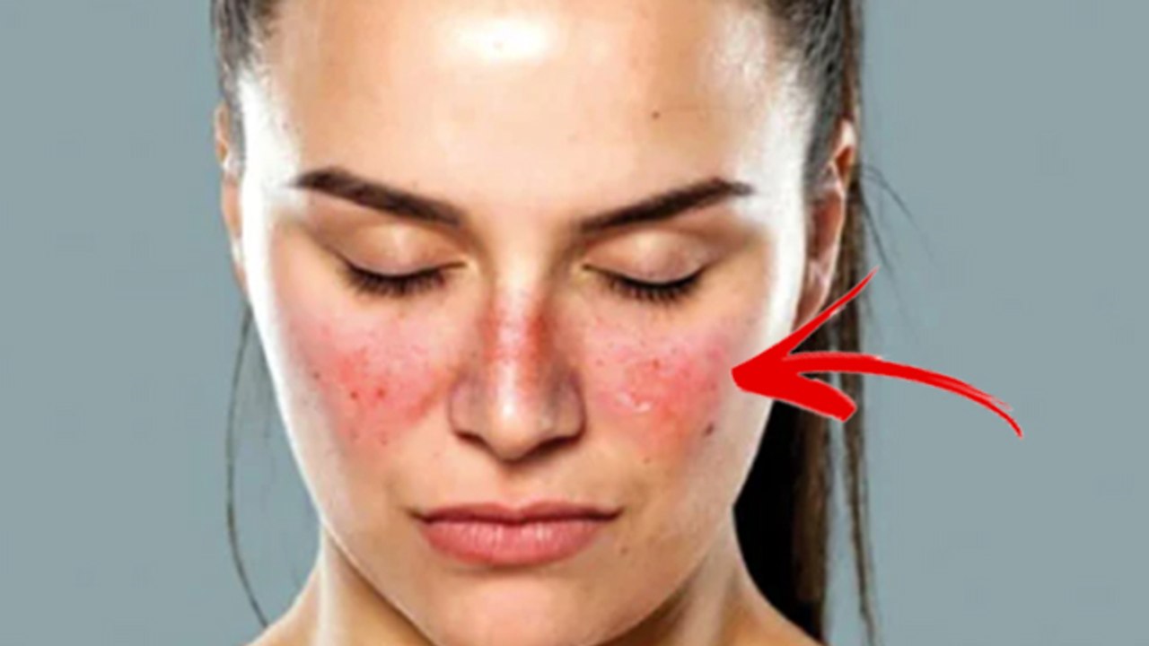 ल्यूपस रोग क्या है |  ल्यूपस के लक्षण क्या है | Lupus Kya Hota Hai | Lupus Symptoms | Boldsky