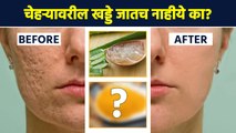 चेहऱ्यावरील खड्डे नेमके घालवायचे कसे? | How to Get Rid of Acne Scars | Acne Scars Treatment | AI2