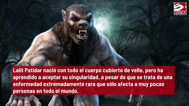 Un adolescente indio padece el síndrome del hombre lobo