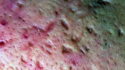 pimple acne removal 6