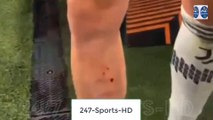 Adrien Rabiot leg bloodied and bruised by nasty tackle that ref ignored despite it being ‘clear penalty’ for Juventus