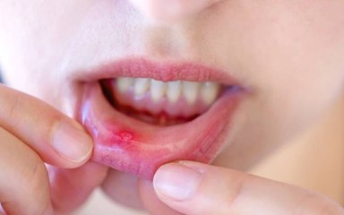 Ortodontista sousense explica diferença entre sapinho e afta e dá dicas para o tratamento correto