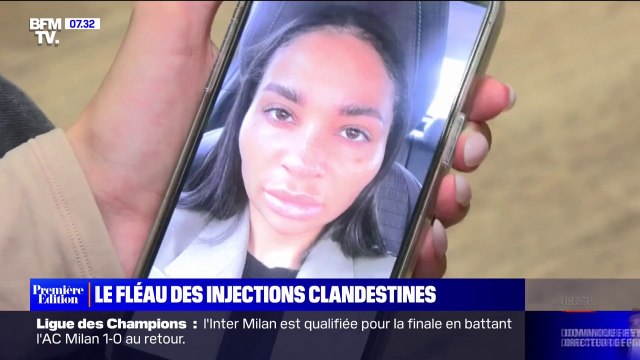Ma lèvre allait exploser : victime d'une fausse praticienne, elle témoigne de ses injections à l'acide hyaluronique