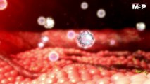 Terapias contra el Melanoma: Detección temprana y cirugía micrográfica de Mohs