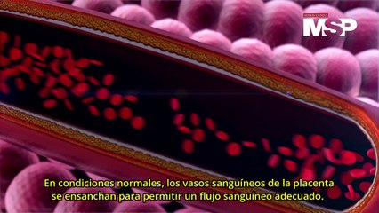 ¿Qué es la preeclampsia o hipertensión gestacional? - Día Mundial de la Hipertensión