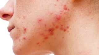 bd-causas-y-tratamientos-del-acne-tardio-180523