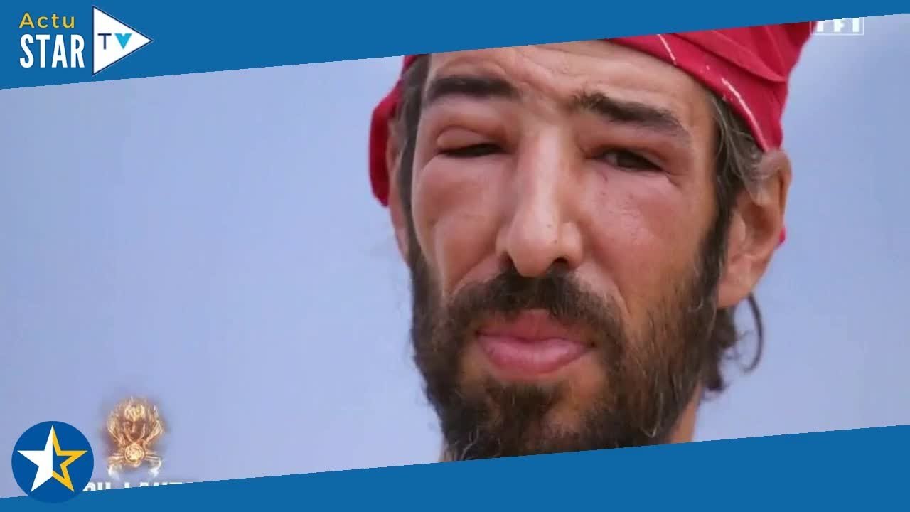 Esteban (Koh-Lanta) ne sait pas s'il a fait une allergie à l'oeil : "Je n’ai aucune idée de ce qu’il