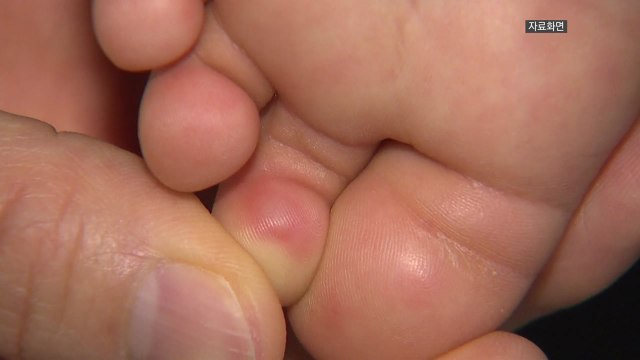6세 이하 영유아 수족구병 급증... 한 달 새 3배 이상 늘어 / YTN