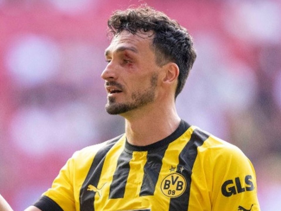 'Das war es wert': Mats Hummels zeigt sein blaues Auge