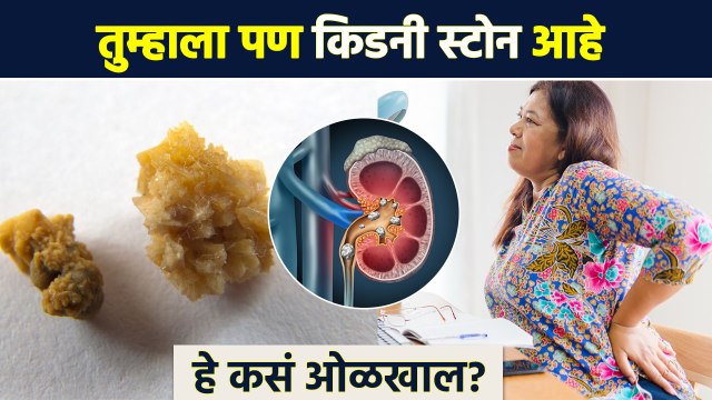 किडनी स्टोन झालाय हे कसे ओळखाल? | How to Identify Kidney Stones | Kidney Stones Symptoms | AI2
