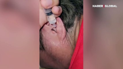Görenler inanamadı: Adamın kulağından bir anda böyle çıktı!