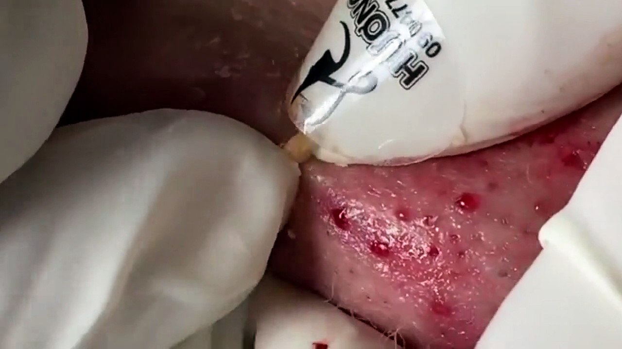 ASMR Treatment and clears swollen and smelly eyes PArt 2